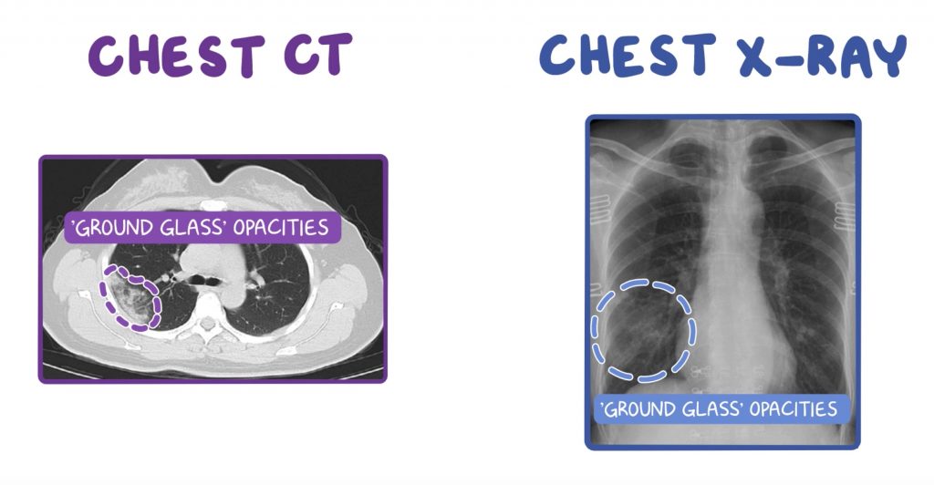 Diagnosing CoronaVirus Covid19 CT scan vs RTPCR Medical Odyssey