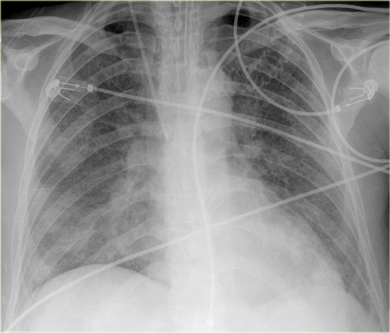 Pleural Effusion vs Pulmonary Edema – Medical Odyssey