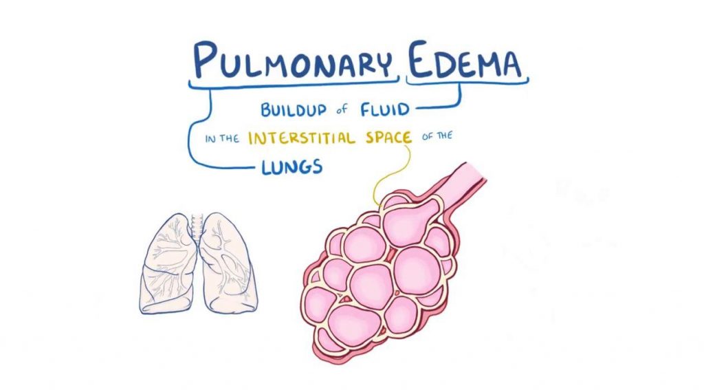 Pleural Effusion vs Pulmonary Edema – Medical Odyssey